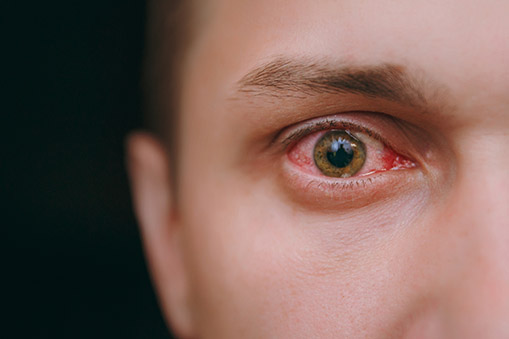 8 dicas para evitar alergias e infecções nos olhos